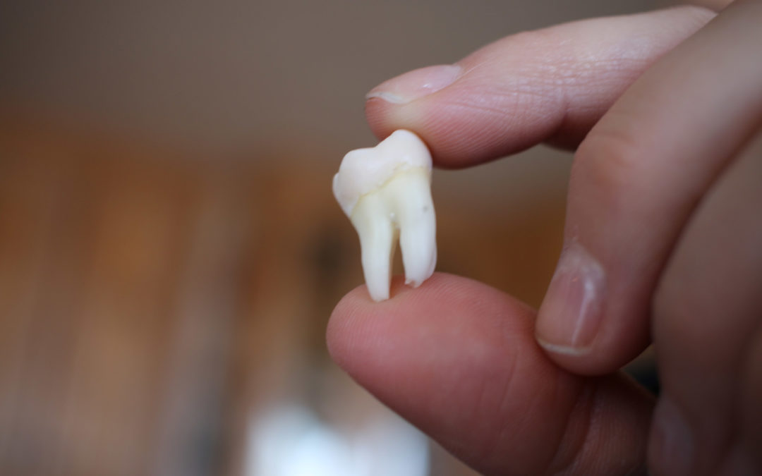 Health Hint! –Wisdom tooth impaction and early detection signs